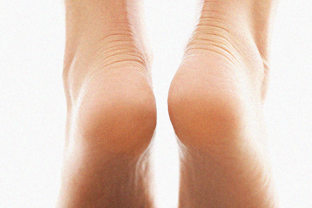 Dor no calcanhar: pode ser fascite plantar. Doctor Feet Podologia